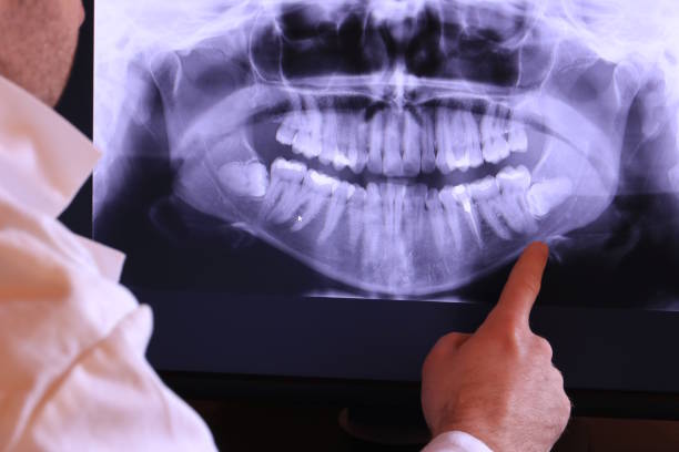 Best Knocked-Out Tooth (Avulsed Tooth) Treatment in Columbus, KS