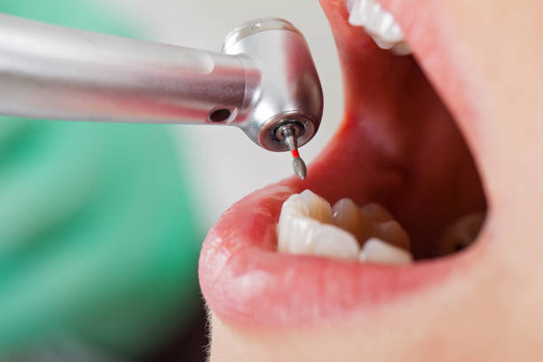 Best Emergency Wisdom Tooth Extraction in Columbus, KS